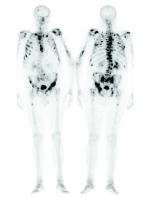 bone scan nuclear medicine metastasis metastases prostate disease metastatic skeletal osteomyelitis widespread services
